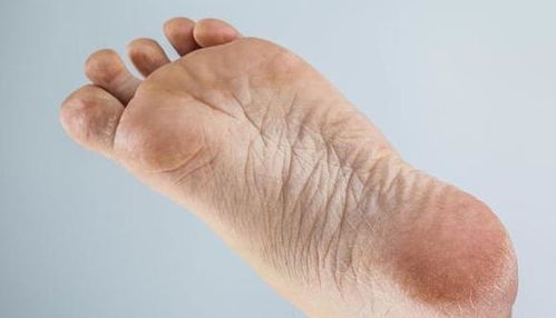 手脚出现3大 异常 ,多半是肝病缠身的 预兆 ,早知早预防