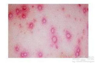 斑疹是由什么原因引起的