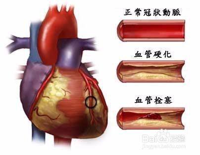 动脉粥样硬化是这样的一种病,知道了就要重视起来