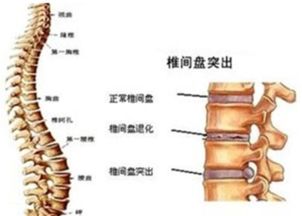 腰椎间盘突出其实也可以用这方法来治疗 