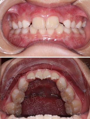 排齐都保证不了,还能指望早期矫正给孩子带来啥