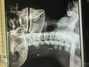 颈椎斜位片摆位图 搜狗图片搜索