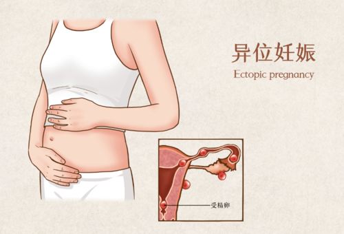 输卵管粘连会宫外孕吗能考虑试管辅助生育吗？