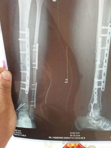 小腿左胫腓骨骨折术后的的片子请太夫们帮忙看一下愈合情况怎样第一张是术后一个半月拍的第二张是三个月拍 