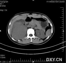 一个有意思的CT片