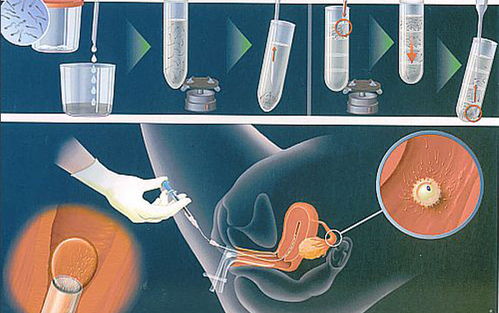 试管胚胎移植后为什么需要保胎呢？