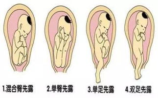 胎儿臀位为什么要剖宫产 臀位顺产有哪些风险 