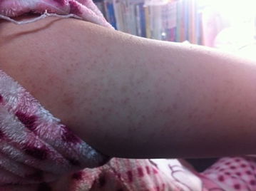 女孩子手臂上的痘痘是什么原因