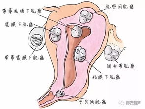 和您聊一聊子宫肌瘤