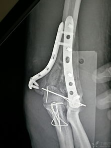 肱骨髁间粉碎性骨折双钢板固定体会