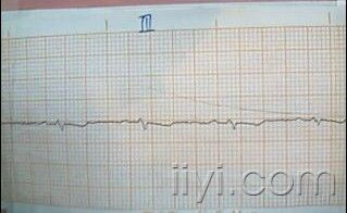 医学问题  心电图
