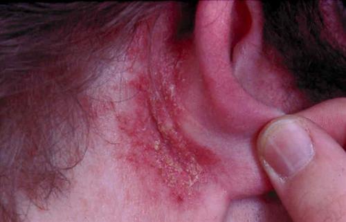 1,耳朵感染耳朵感染是指耳朵内部或外部受到感染
