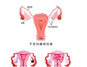 子宫内膜移位的原因 子宫内膜移位的原因是什么