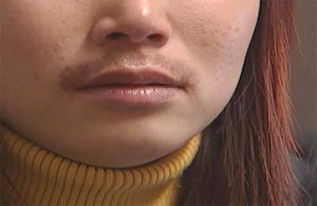 女生长胡子怎么办 光拔是不顶用的 严重可能导致不孕
