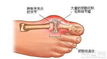 痛风的饮食禁忌 多吃这些有害无益