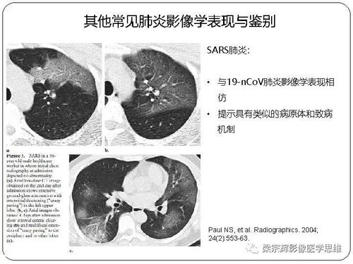 新冠患者的早期症状是什么（新冠病毒患者早期有哪些症状） 第1张