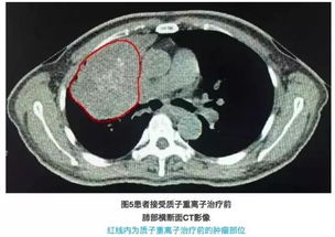 体积巨大型肺癌更适合质子重离子精准放射治疗