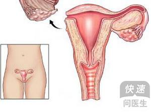 卵巢囊肿手术后还会复发吗 如何防止卵巢囊肿复发