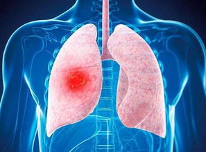 肺癌最容易转移到4个地方,当身体出现这些反应,要警惕肺癌转移了 
