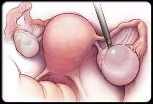 【妇产科普】当孕期遭遇卵巢囊肿