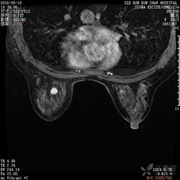 乳腺肿块,良性还是恶性 很有提示意义的病变 已经公布病理结果