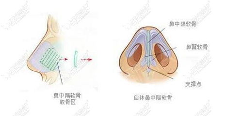 鼻中隔软骨隆鼻争议这么大是因为鼻中隔取完鼻子会塌陷吗