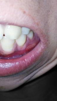 我的牙龈上长了一个白色的东西,看起来有点像口腔溃疡但是又不怎么痛 有时还有分泌物,都十天了还没好, 