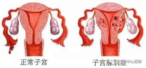 健康科普丨快绝经了,我的月经病还需要管理吗