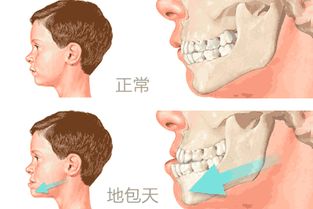 地包天要怎么矫正 