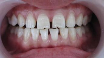 牙间隙可以做牙贴面修复吗 