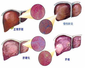 肝癌晚期抽腹水的利弊各是什么(肝癌晚期抽腹水好不好)