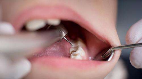 预防儿童蛀牙,家长必须要关注的两个时期