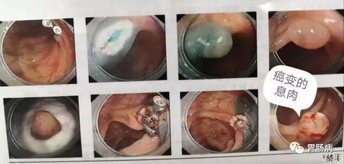 肠镜检查的重要性 一次肠镜检查可管五年 十年内没问题