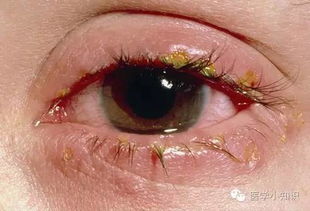 红眼病的原因 症状及治疗 
