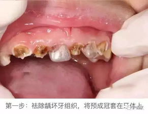 孩子蛀牙很严重 这样处理更专业 