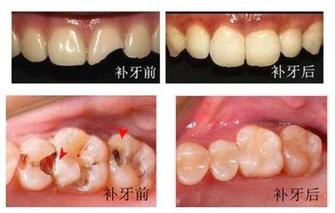 苏州补牙需要杀神经吗