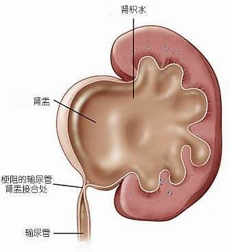 怎么治疗输尿管结石引起的肾积水,方法有这几种