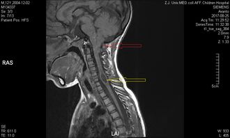 术前磁共振提示胸8 9椎体水平脊髓受压 图片欣赏中心 急不急图文 Jpjww Com