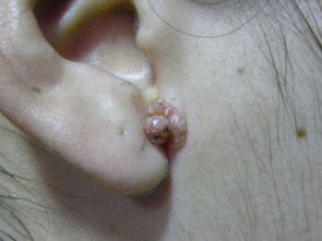 耳朵旁边长了小肉球越长越大是什么 