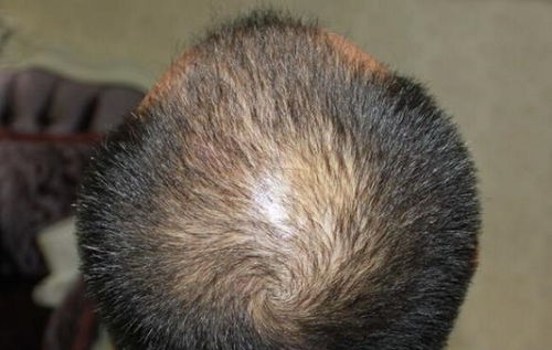 前额头顶脱发怎么办 什么方法可以治疗,还能恢复吗