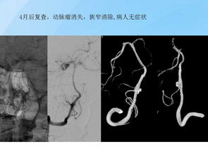 不同类型颅内支架在脑动脉瘤治疗中的应用 