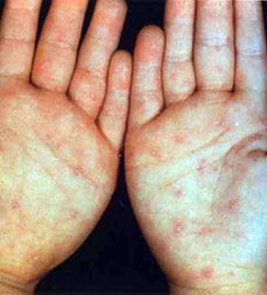 手足口病防治指南 儿童手足口病症状及预防控制指南