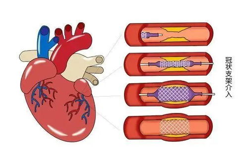 消失了的心脏支架,闯出 心病 患者的另一条生路