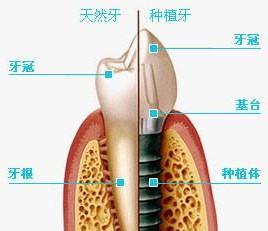 种植牙为什么不便宜