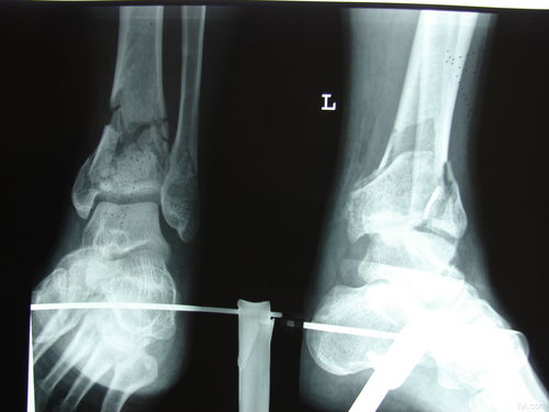 双侧pilon骨折 骨科与显微外科专业讨论版 爱爱医医学论坛 