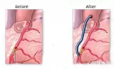 治疗冠心病心脏支架和搭桥哪个好
