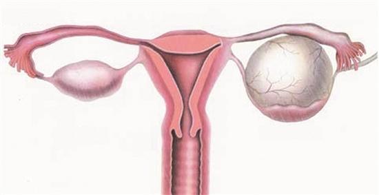 卵巢囊肿的备孕,卵巢囊肿会影响备孕吗