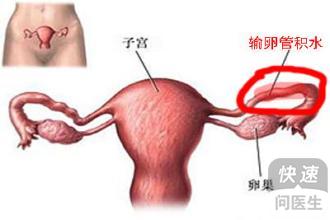 检查输卵管积水的方法