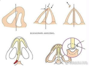 为什么不建议取鼻中隔整鼻(为什么很多医生不建议鼻中隔手术)