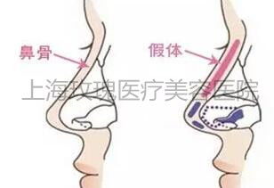 塌鼻子该怎样选择隆鼻